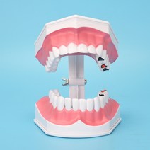 치아모형 모델 의사 교육 브러시 틀니 준비 연습 구강 장식품, 충치로 2회 업그레이드 아래 치아를 느슨하게 할, 충치로2회업그레이드 아래치아를 느슨하게할수있음