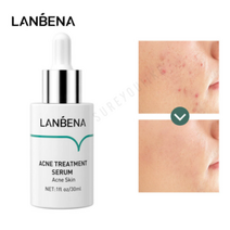 SUREYOULiKE Acne Treatment Serum LANBENA Anti-Acne Serum with Salicylic Acid Acne Pimple an