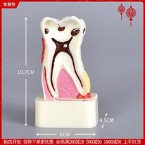 치아모형 재료상 입모형 모양 치아 모형 구강 강의 치과 임플란트, 03 4016 4배 치아 분해 모델