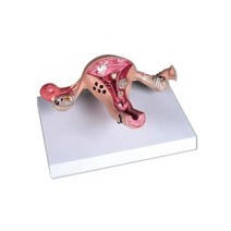 자궁의 병리모형 L262/여러 질병을 표현/사이즈 23x16x6cm