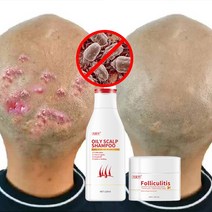 지루성 두피염 샴푸 머리습진 건선 두피각질 샴푸 두피가려움 샴푸세트, 120ml+30ml
