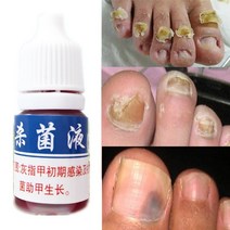 발뒤꿈치각질제거 발바닥각질제거 전동발각질제거기 anti 감염 fungal nail 손톱