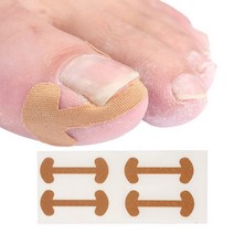 발톱파고들때 테이프 내향성 내성 관리 밴드 발가락 네일 테이핑 1세트
