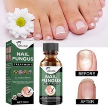 손톱 내성발톱 무좀 곰팡이 연화제 항균 큐티클 오일 에센스 수리 혈청 치료 혈청 onychomycosis paronychia 항진균 감염 발가락 발 수리 도구, 네일 리페어 세럼