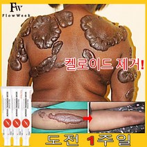 1+1 스카 리무브 크림 켈로이드 리무브 트러블 스팟 트리트먼트 스트레치 마크 화상 수술 스카 스무딩 화이트닝 색소 침착 스킨 케어, 06. 20Pcs Scar Cream