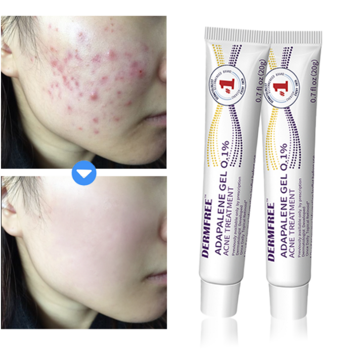DERMFREE 여드름 제거 리페어 크림 스팟 케어 문제피부 자국 모공 진정 피지케어 연고, 2개, 20g DERMFREE 여드름 제거 리페어 크림 스팟 케어 문제피부 자국 모공 진정 피지케어 연고, 2개, 20g
